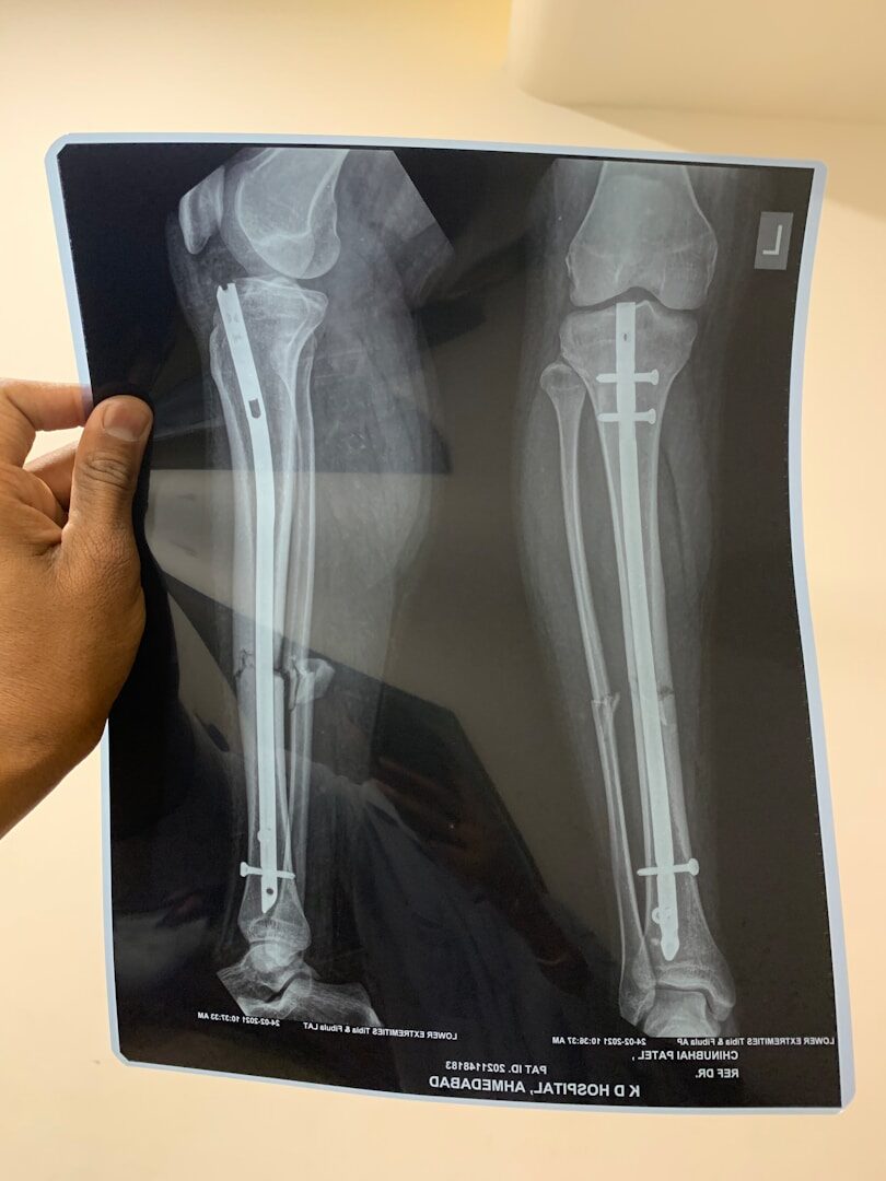 Em pessoas idosas, as fraturas ósseas são um problema muito complicado. Infelizmente, elas ocorrem com frequência, especialmente em mulheres.