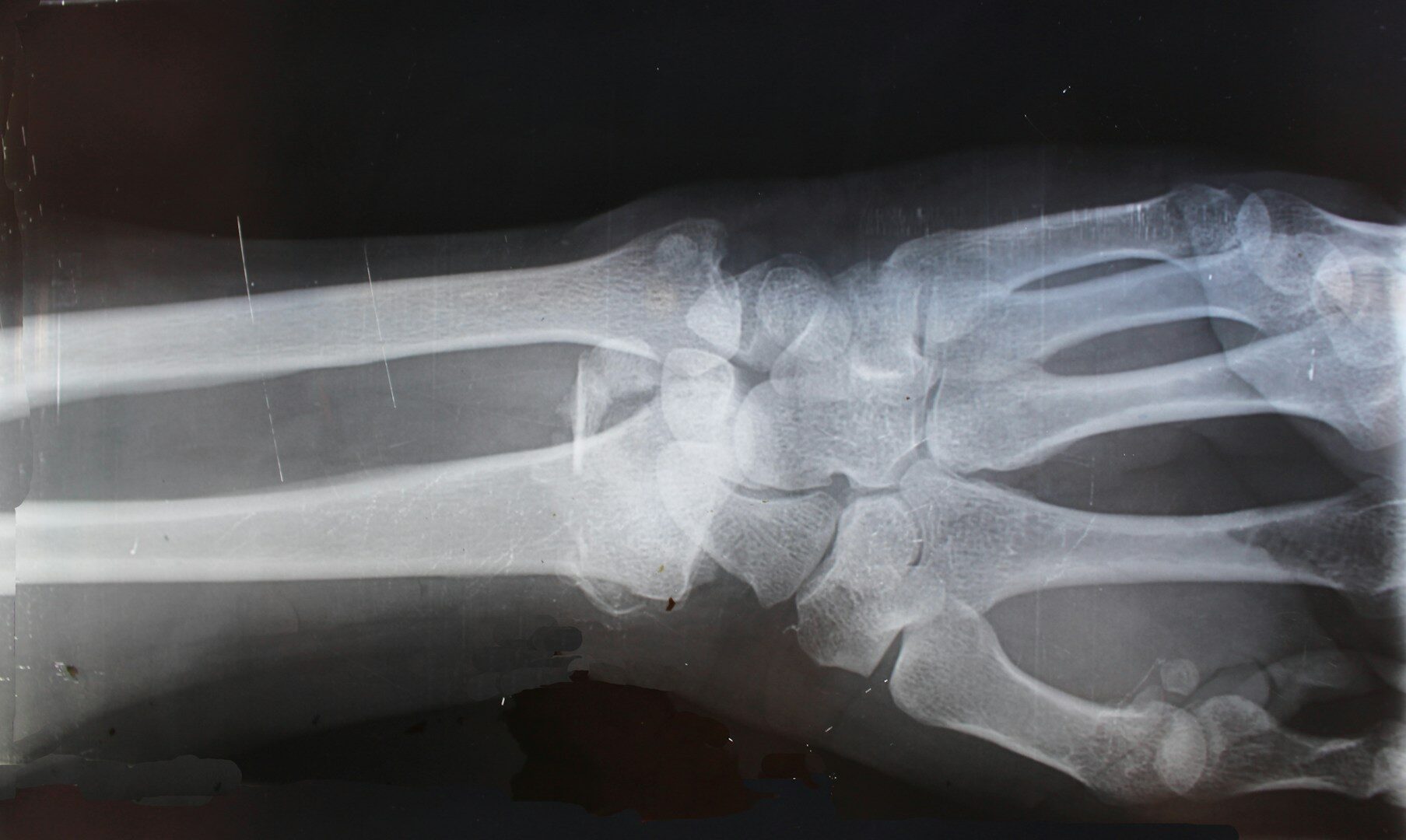 O inchaço aparecerá. As radiografias mostrarão uma fratura. Mas você não sentirá nenhuma dor.